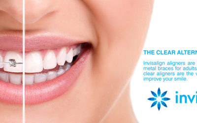 Invisalign: Know Before You Go  | Dentist Fresno CA