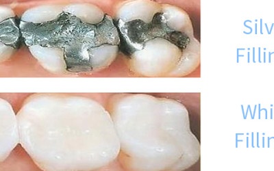 Silver’s Not your Best Option | Fresno Dentist