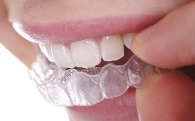 Invisalign: The Clear Alternative | Invisalign in Fresno