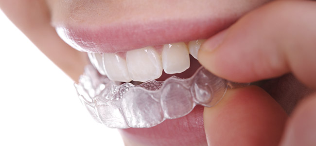 Invisalign in Fresno | General Dentistry | Dr. Donan DDS