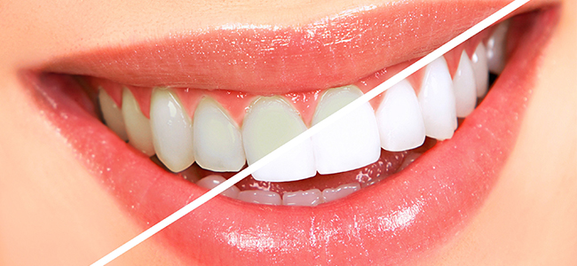 Whitening For Every Smile! Get Yours | Fresno Dentist