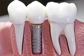 Not magic, it’s Dental Implant