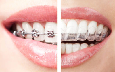 The Basics of Braces