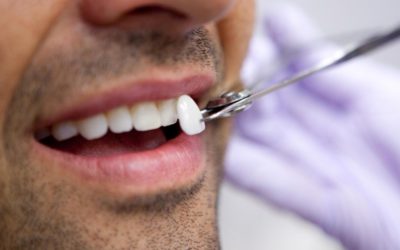 Dental Veneers at Dentist Fresno CA