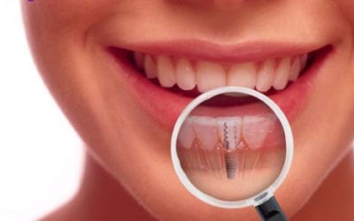 What Are Dental Implants? | Dentist Fresno CA