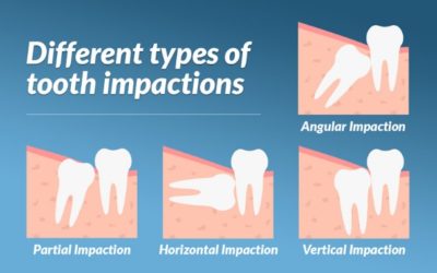 Wisdom Teeth in Teenagers | Dentist in Fresno CA