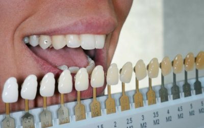 How Do I Know What Shade My Teeth Are? | Dentist Fresno CA