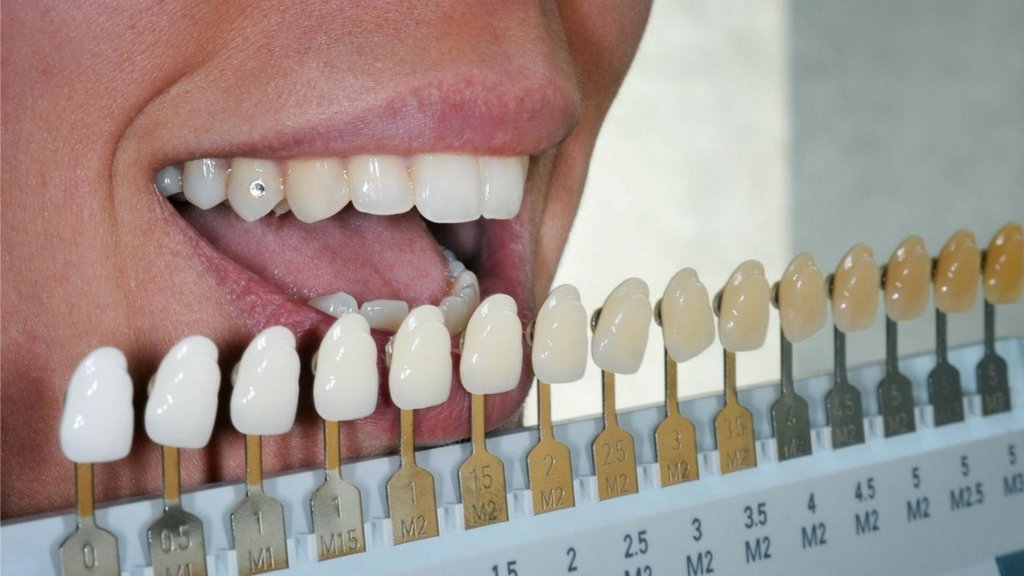 Dental Tooth Shade Chart