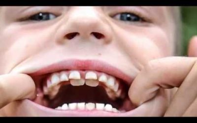What happens if your child has two rows of teeth? | Dentist Fresno CA