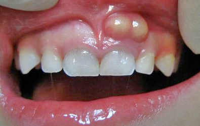Tooth Abscess: How to Identify, Treat, and Prevent