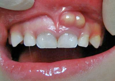 Dental Abscess: Symptoms, Causes, & Treatment - Share Dental Care