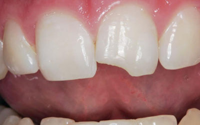 Broken teeth, what to do?