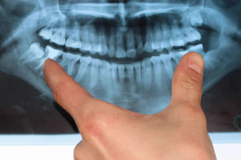 Wisdom Teeth Coming In? What You Need to Know Fresno