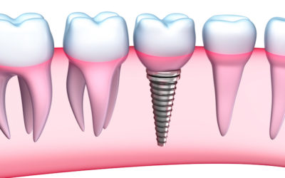 3 Reasons Why You Shouldn’t Be Nervous About Implant Surgery