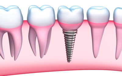 3 Reasons Why You Shouldn’t Be Nervous About Implant Surgery